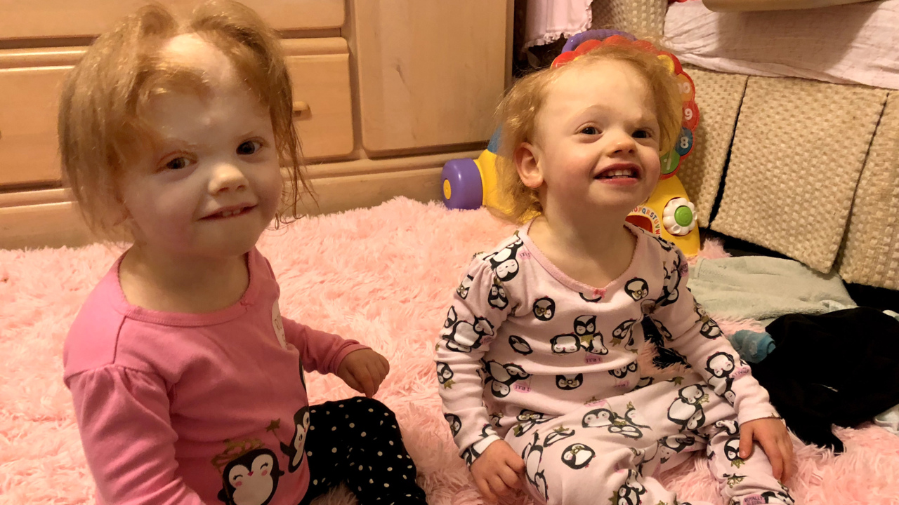 Conjoined NC twins separated; hospital says they’re healthy Durham