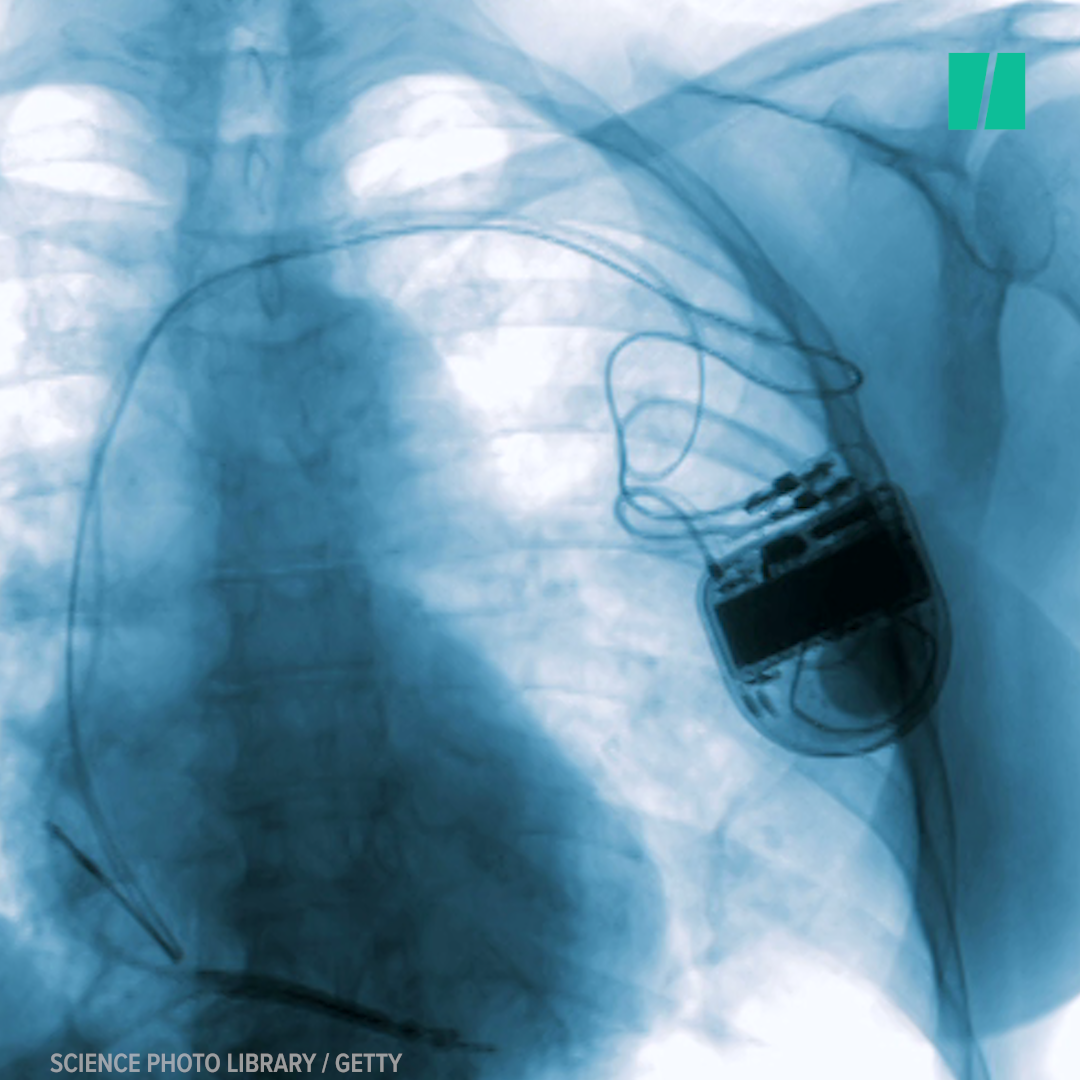 Hacking Risk Leads To Massive Pacemaker Recall | HuffPost Videos