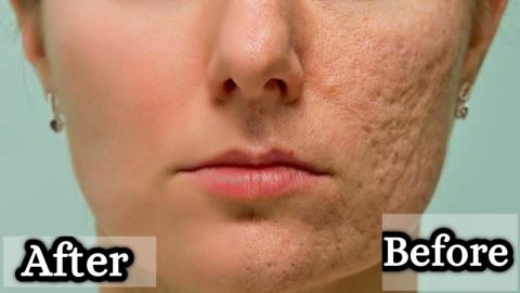 Improve Your Textured Skin With This Natural Homemade Scr...